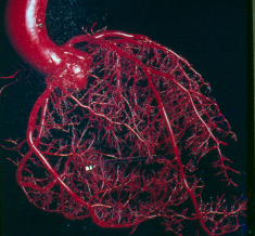 CORONARY ARTERY DISEASE